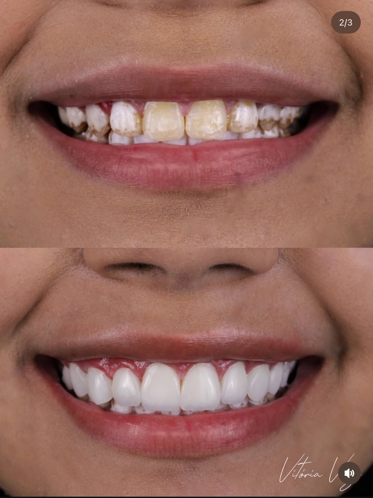 Registro clínico de sorriso reabilitado com resina composta