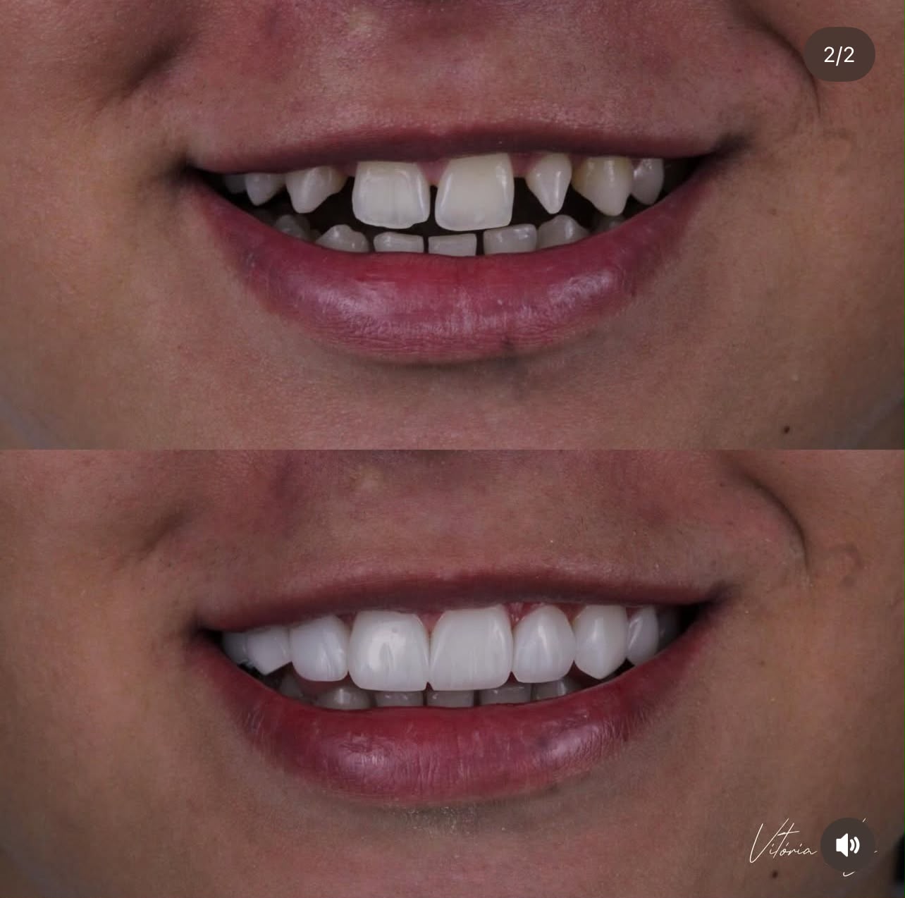 Registro de sorriso com fechamento de espaços em resina composta