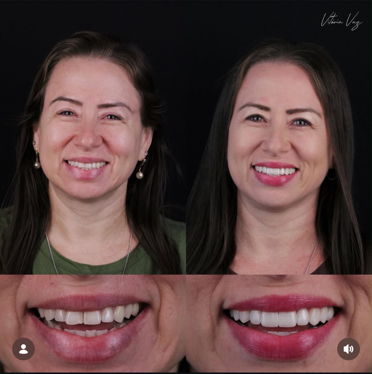 Paciente sorrindo de frente com detalhes aproximados do sorriso