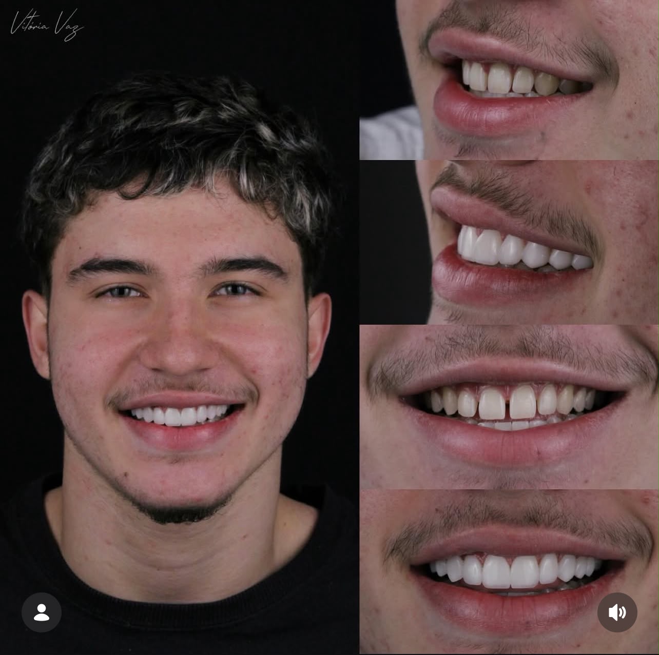 Paciente sorrindo e detalhes do sorriso em diferentes ângulos