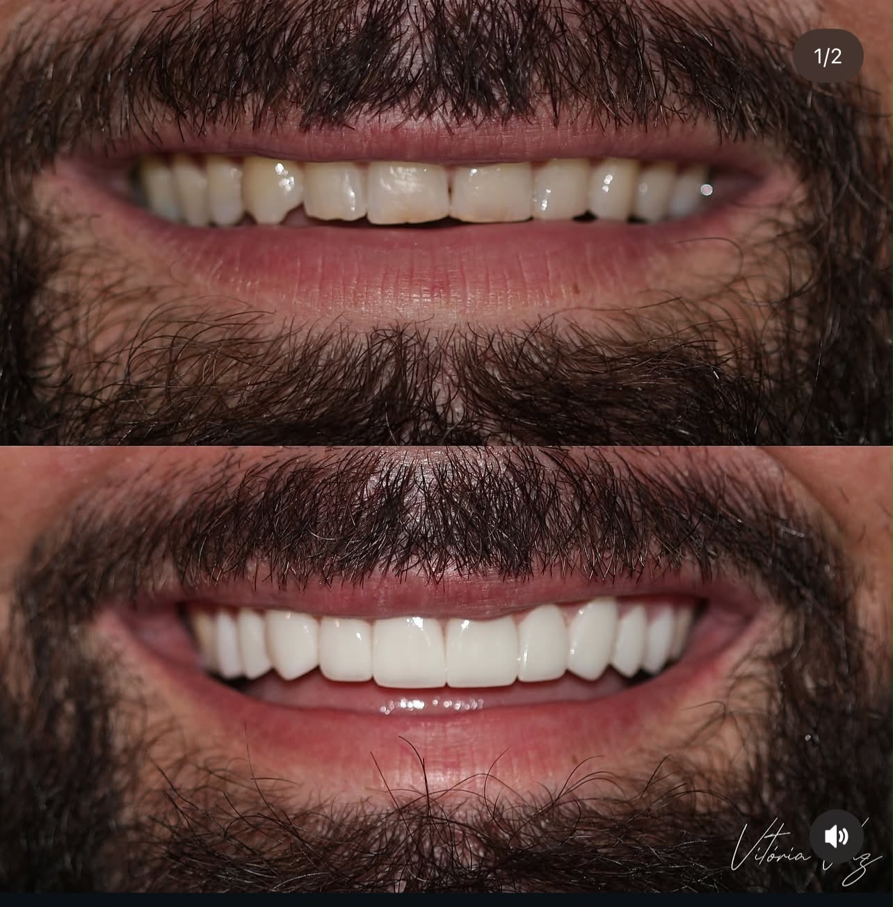 Detalhe de sorriso masculino após lentes em resina composta